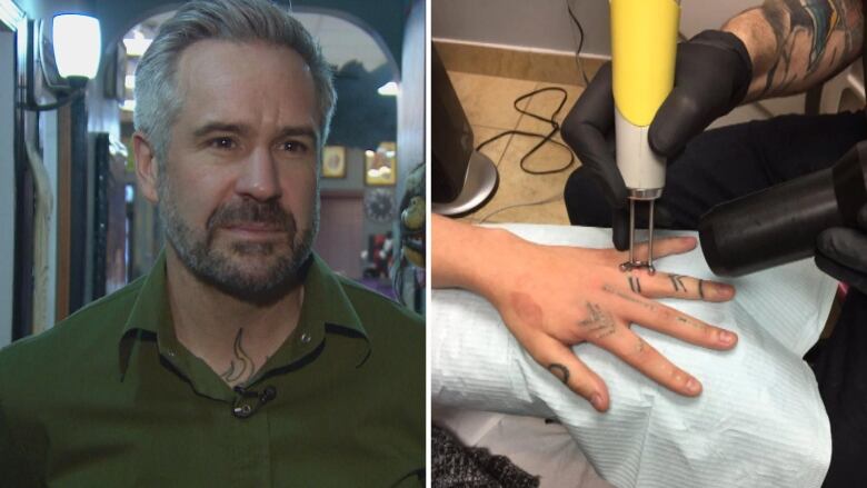 A man with grey hair wearing a green shirt is seen on the left, and a picture of a laser removal device being used on hand tattoos is seen on the right.