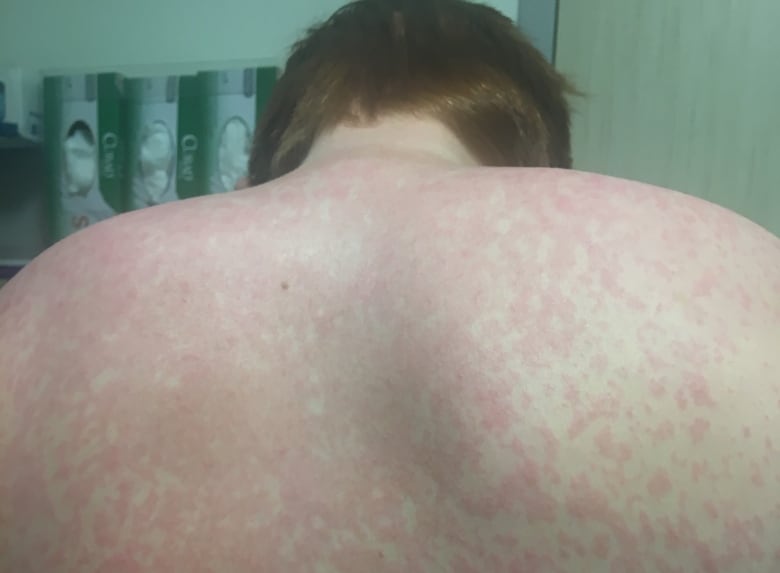 A man with this back to the camera. His back is covered in a faint red rash.