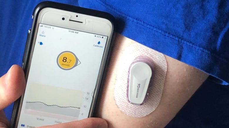 Continuous Glucose Monitor on arm