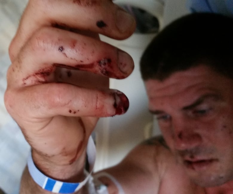 Mitchell DeBoer's hand and face are shown in the hospital after his arrest by Vancouver police officers on June 28, 2015.