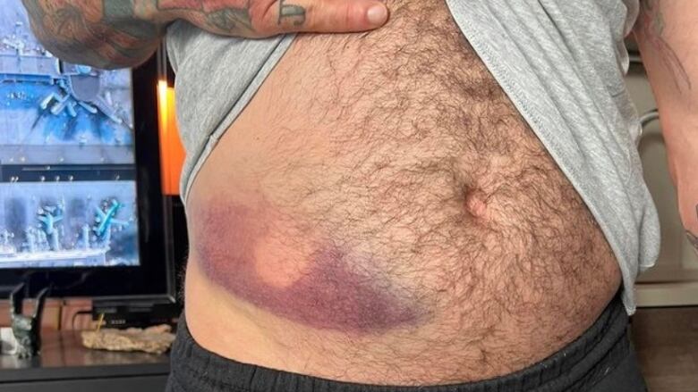 A man lifts his shirt to reveal a large bruise on his stomach area above his hip caused by a bean bag round shot by police.