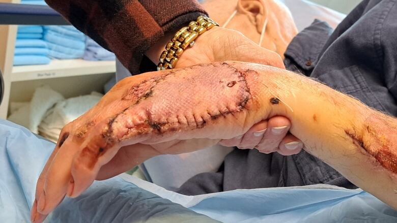 A close-up of a man's hand with a skin graft and visible stitches.