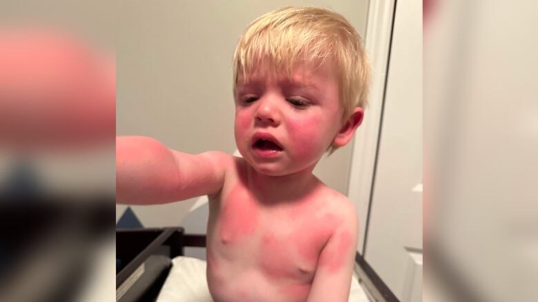 A crying boy reaches out his arm and his body is covered in redness.