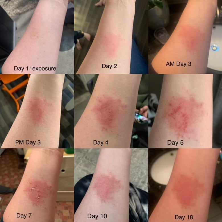 Photos of skin rashes on an arm.