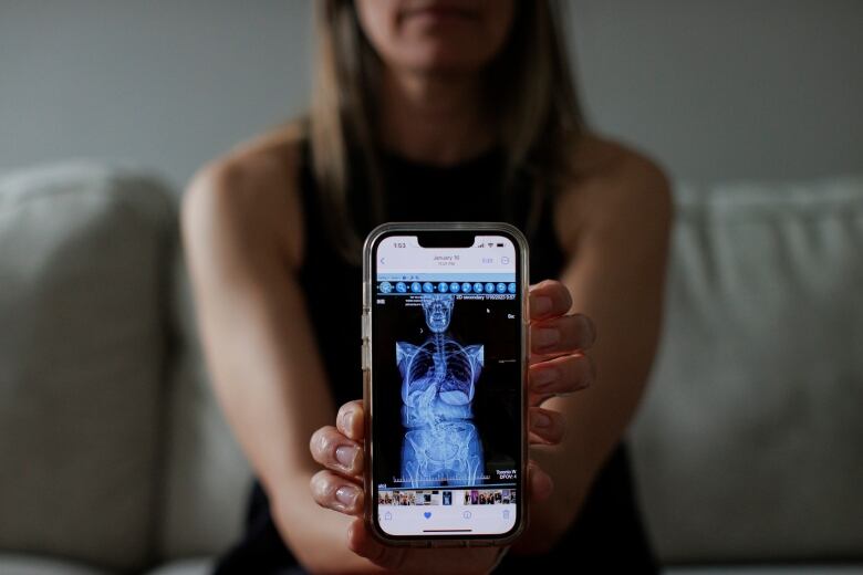 Christine Kaschuba holds up her phone, showing an x-ray of her spine, which is curved in a C-shape due to her severe scoliosis.