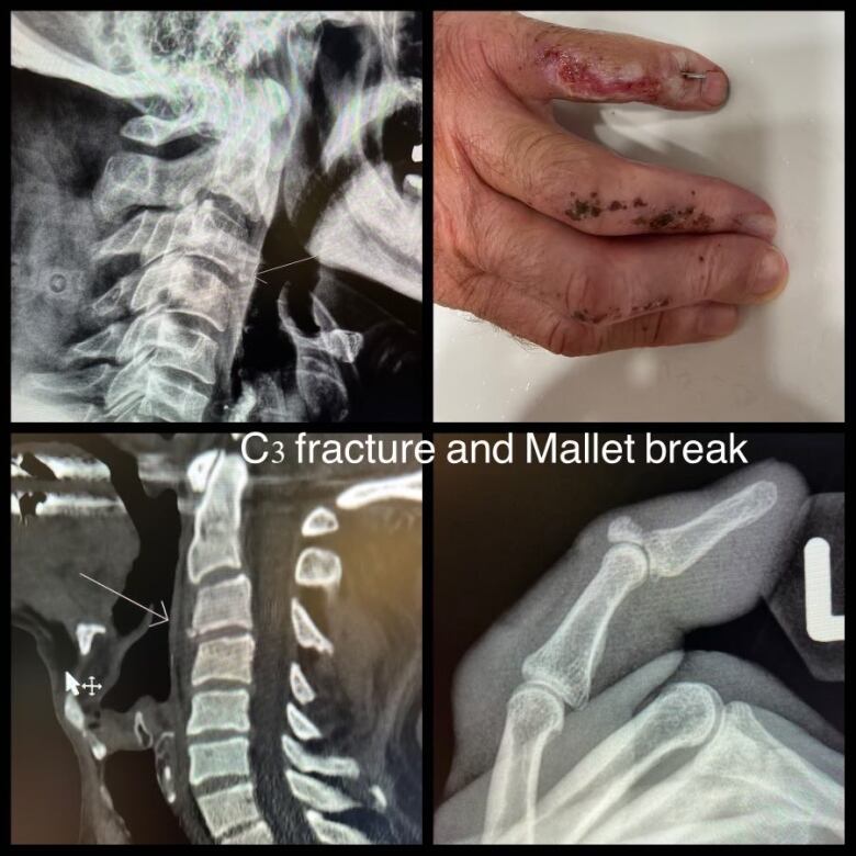 A collage of four photos. The top left photo is of a spine X-Ray. The top right photo is of bloody hand. The bottom left photo is another spine X-Ray. The bottom right photo is an X-Ray of an injured finger. There is text on top of the photos that read 