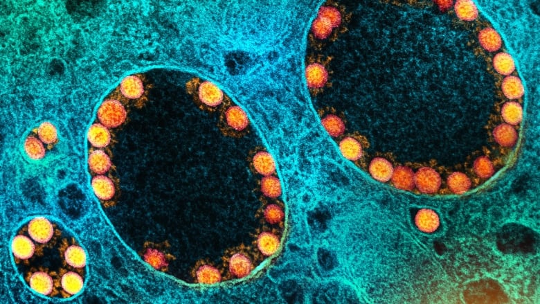 Transmission electron micrograph of SARS-CoV-2 virus particles within a heavily infected nasal Cell. Image captured at the NIAID Integrated Research Facility (IRF) in Fort Detrick, Maryland. Credit: NIAID