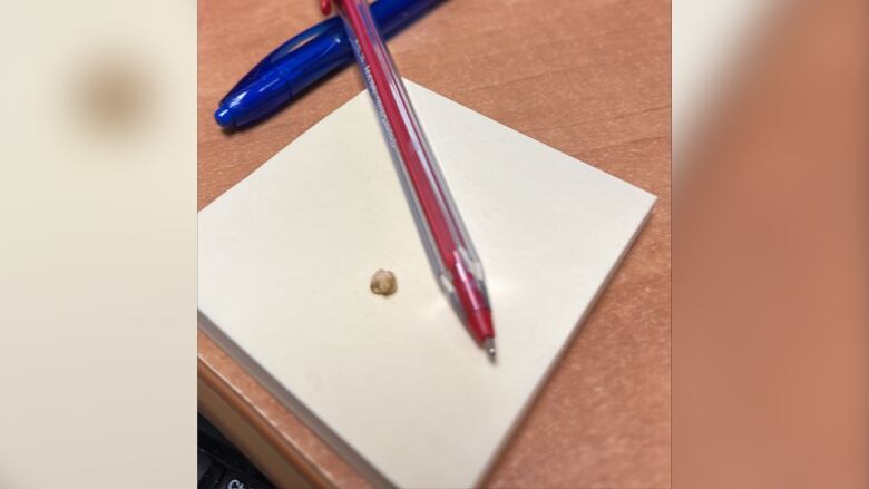 A popcorn kernel-sized stone from an abscess is seen next to a couple pens for scale.