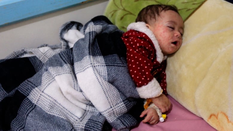 A Yemeni child receives treatment for measles in the Huthi-rebel-held Yemeni capital Sanaa, on March 21, 2021.