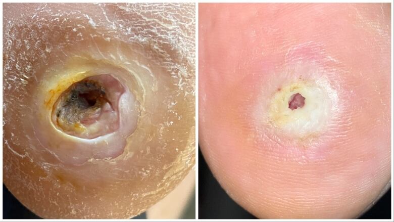 Two photos side by side show an open wound on the bottom of a person's foot. In one photo, the wound is deep and obviously very inflamed. In the second, healing has progressed quite a bit.