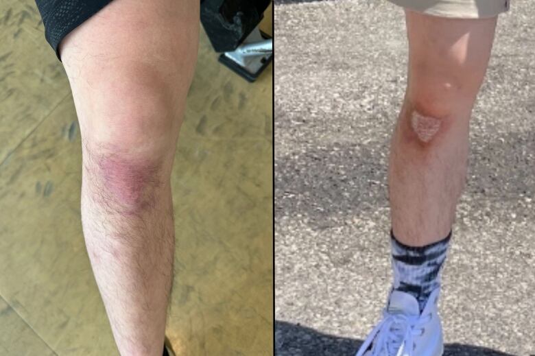 Two photos of a knee, one with scaly white flakes. 