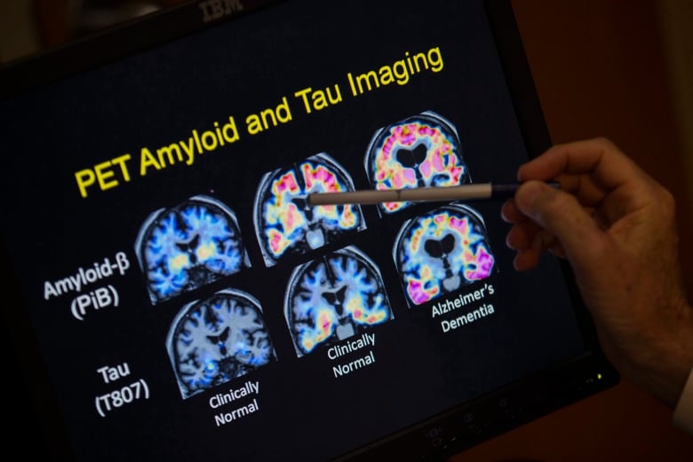 A U.S. doctor points to PET scan results that are part of a study on Alzheimers disease in 2015. Doctors are eyeing blood tests to help them diagnose Alzheimers disease faster and more accurately but they don't all work equally well. 