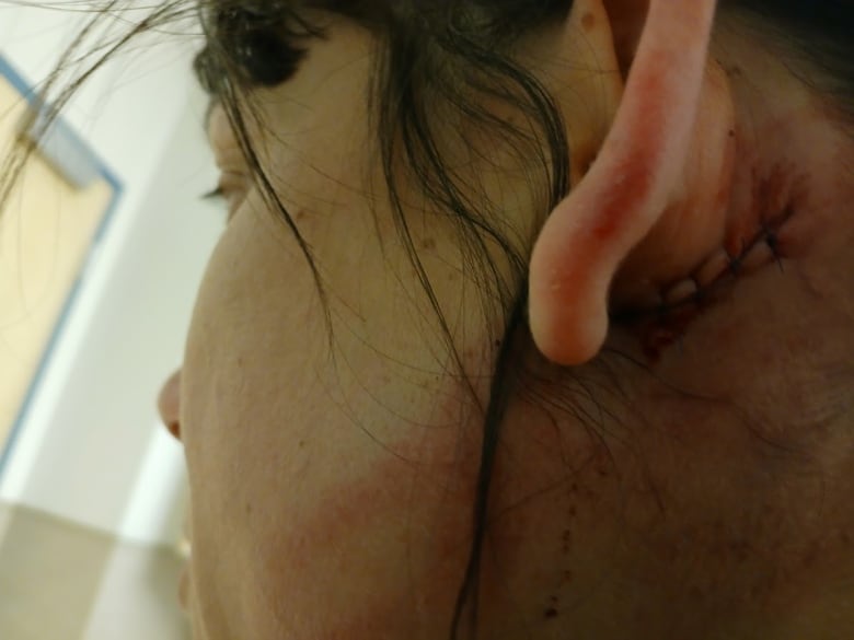 a woman lays on her right side showing a close up of the stitches behind her ear. 