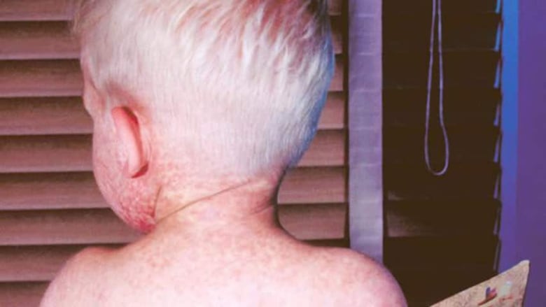 The bare back of a blond-haired boy covered with a measles rash.